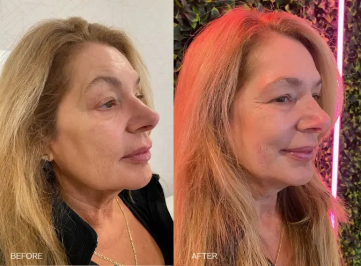 Before and after comparison of a woman’s face treated with Sculptra injections, showcasing natural rejuvenation. The 'before' image reveals sagging skin and wrinkles, while the 'after' image highlights lifted, volumized, and firmer skin. Explore collagen-stimulating Sculptra injections for long-term facial rejuvenation. Book your consultation today! Cleveland, Ohio.