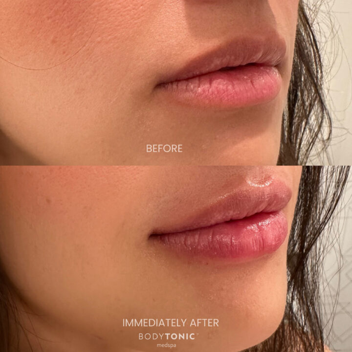 Side profile of a woman showing before and after results of a lip filler treatment at BodyTonic Medspa, with noticeable lip volume