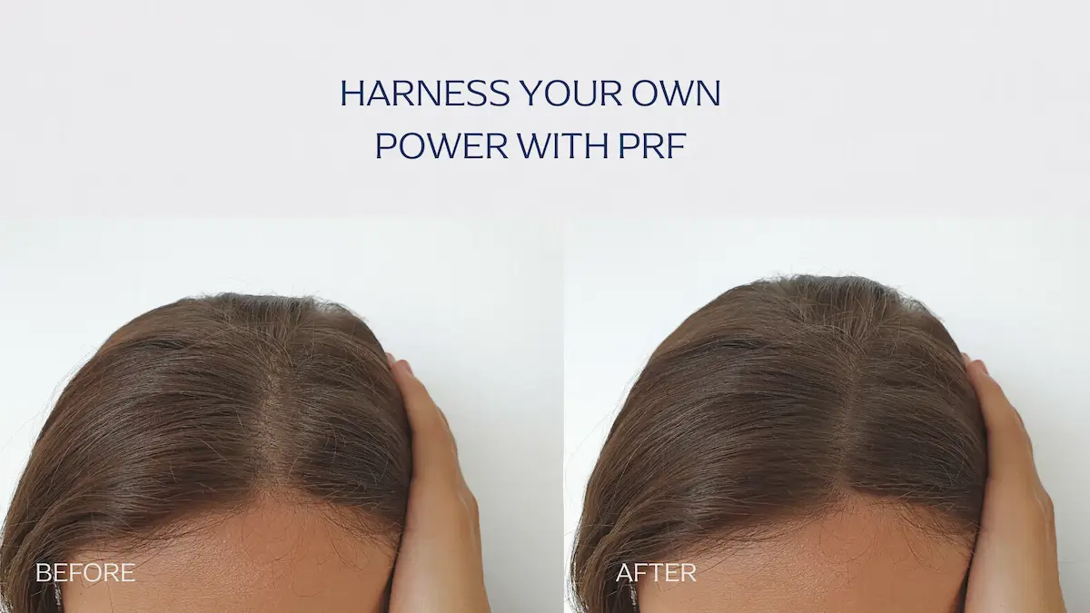 Before and after results of PRF for hair loss treatment in Cleveland, Ohio, showing visibly fuller and healthier hair.