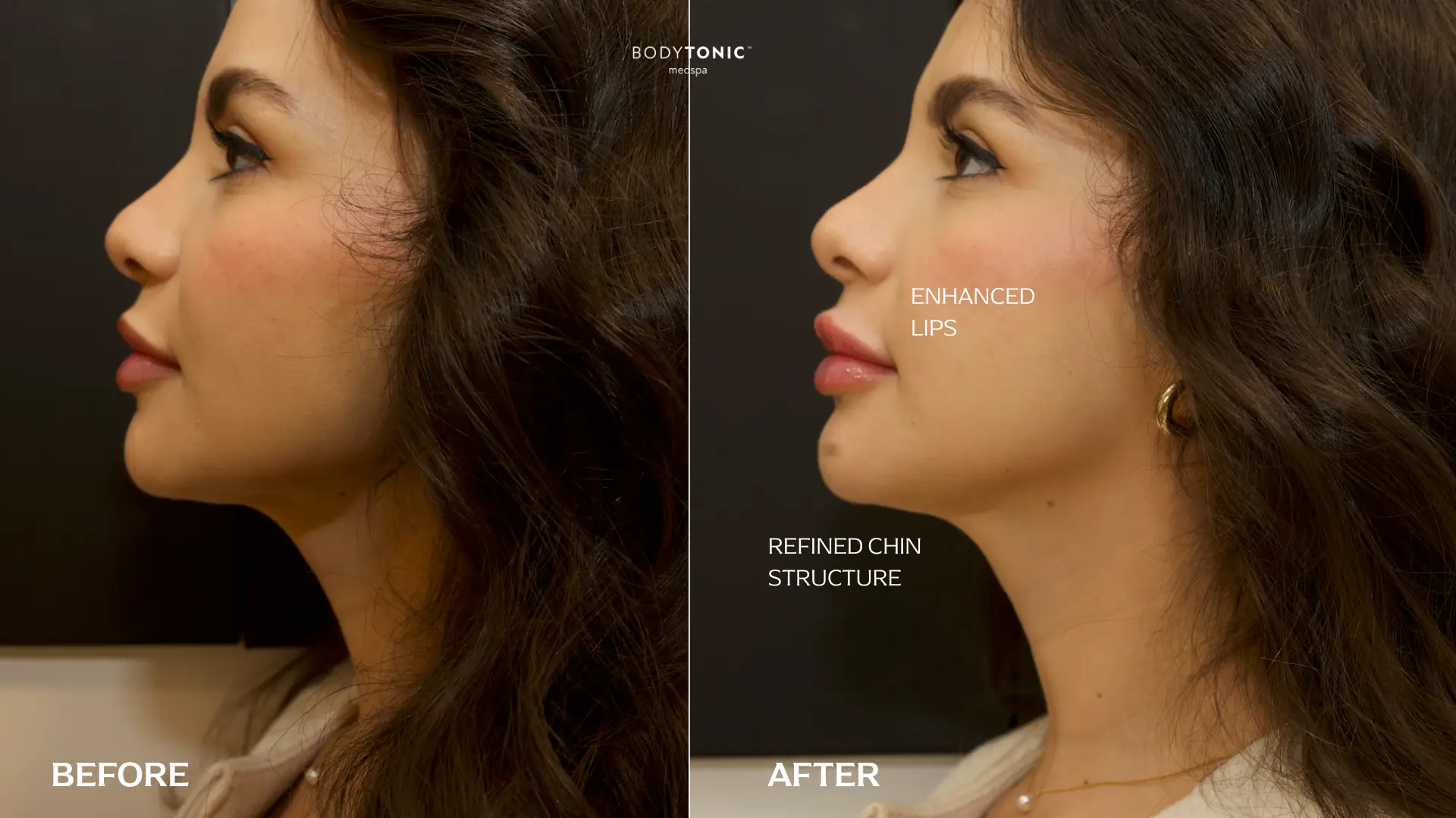 Before and after profile view showing lip enhancement and refined chin structure using Dermal Fillers for Facial Symmetry, creating improved facial balance and proportion. BodyTonic Ohio