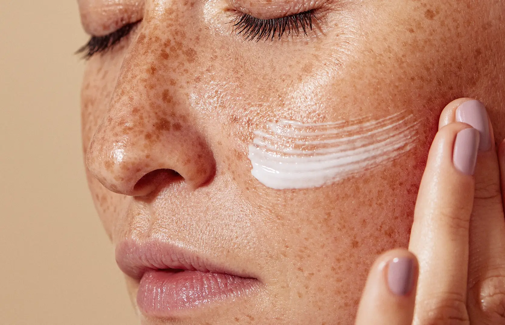 Close-up of freckled skin with skincare cream being applied, illustrating what freckles look like and how they differ in appearance from age spots.