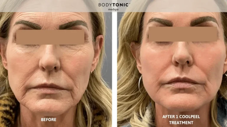 Before and after one Tetra CoolPeel treatment showing reduced wrinkles and smoother skin texture at BodyTonic Med Spa Cleveland.