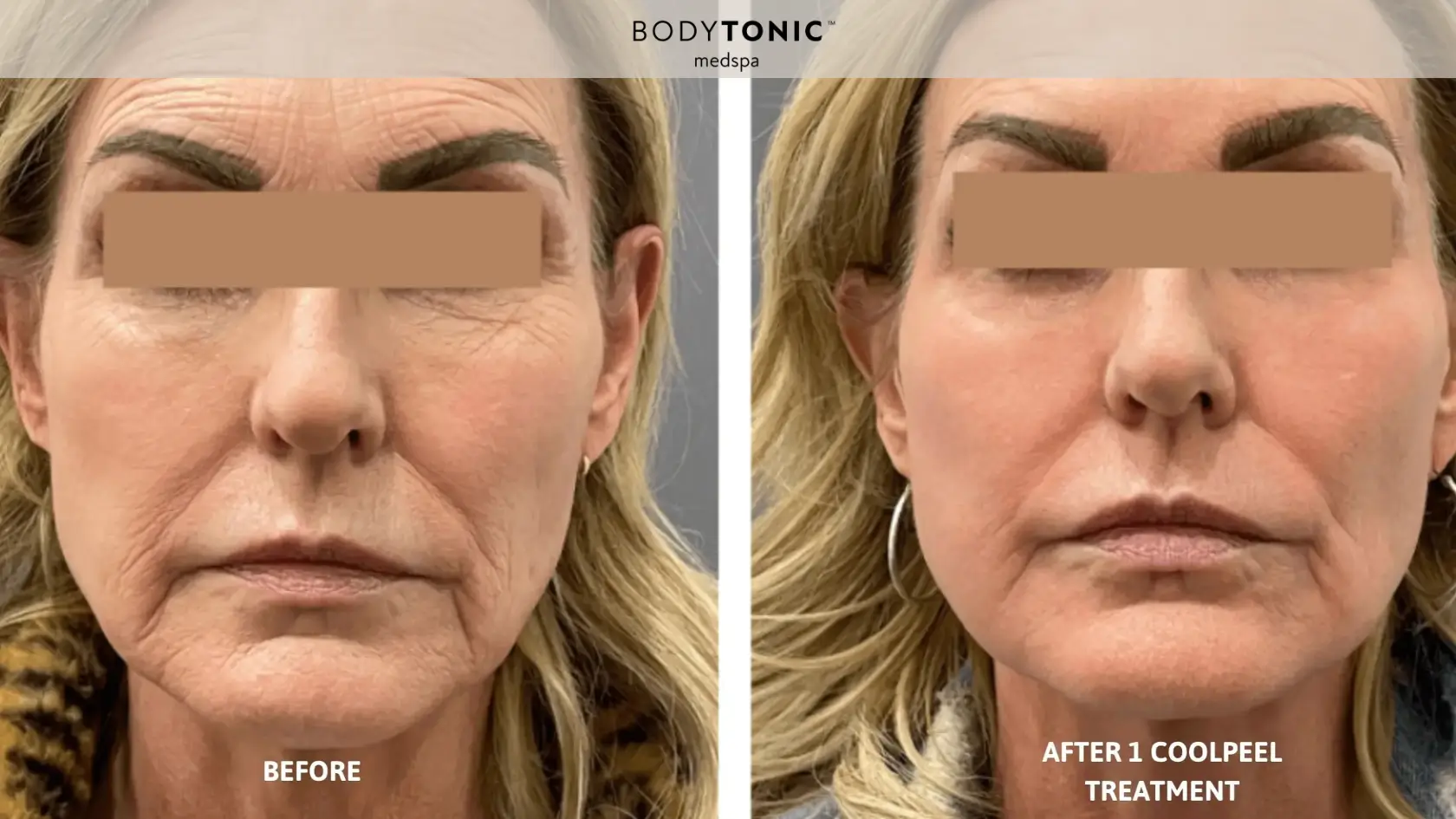 Before and after one Tetra CoolPeel treatment showing reduced wrinkles and smoother skin texture at BodyTonic Med Spa Cleveland.