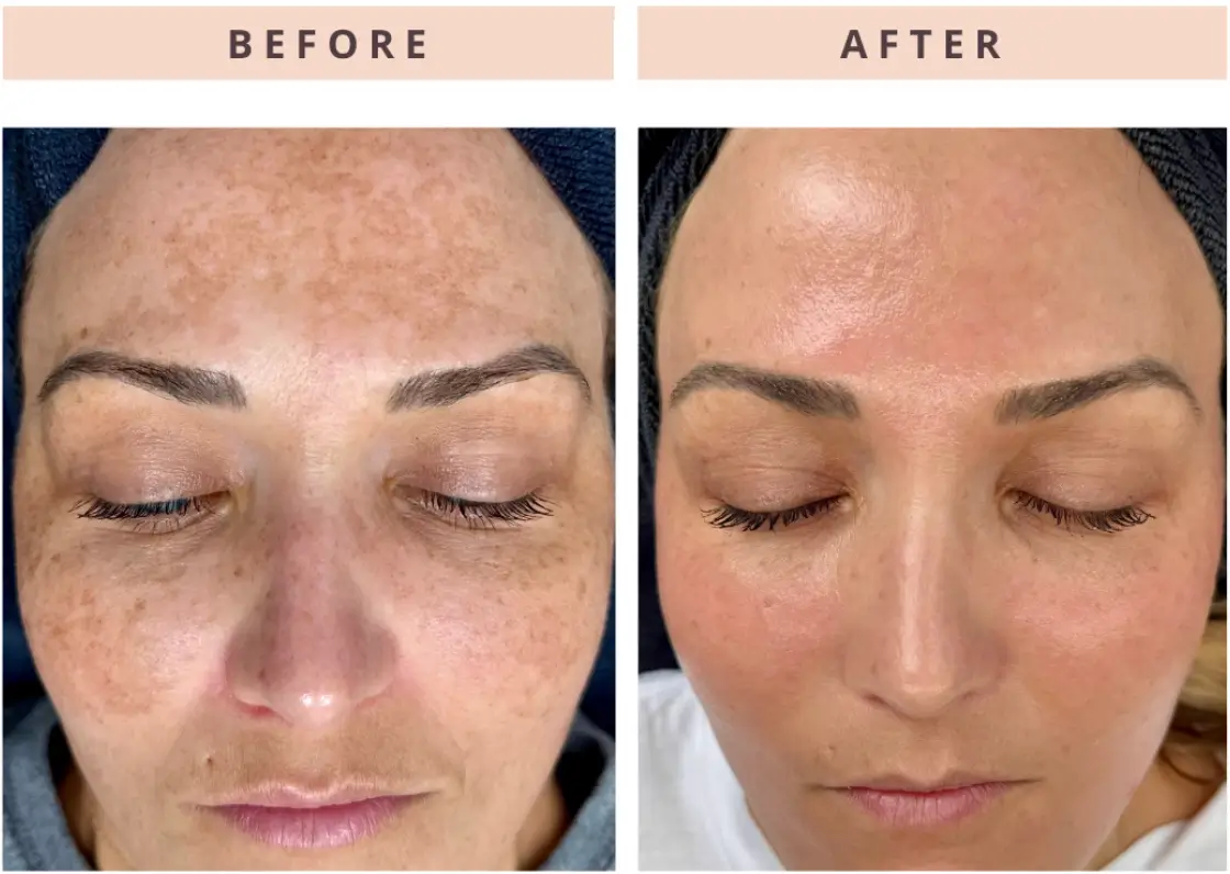 Before and after treatment showing reduction of dark pigmentation, illustrating how sun spots appear on the skin and how they differ from freckles.