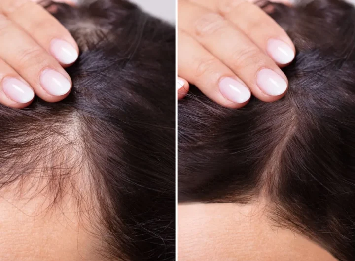 Before and after comparison of hair treated with Exosome Hair Loss Treatment at BodyTonic Medspa in Cleveland. The 'before' image shows thinning hair, while the 'after' image reveals thicker, healthier hair. This non-invasive therapy stimulates natural regrowth with no downtime, starting at $650 per session or $1,500 for a three-treatment package.