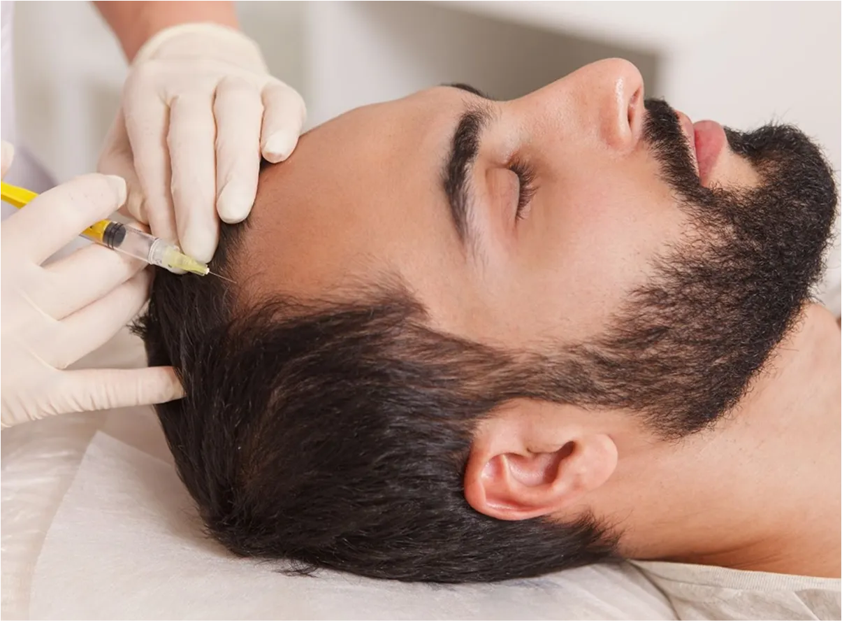 Man lying comfortably while receiving Exosome Hair Loss Treatment along the hairline to stimulate hair regrowth and scalp rejuvenation.