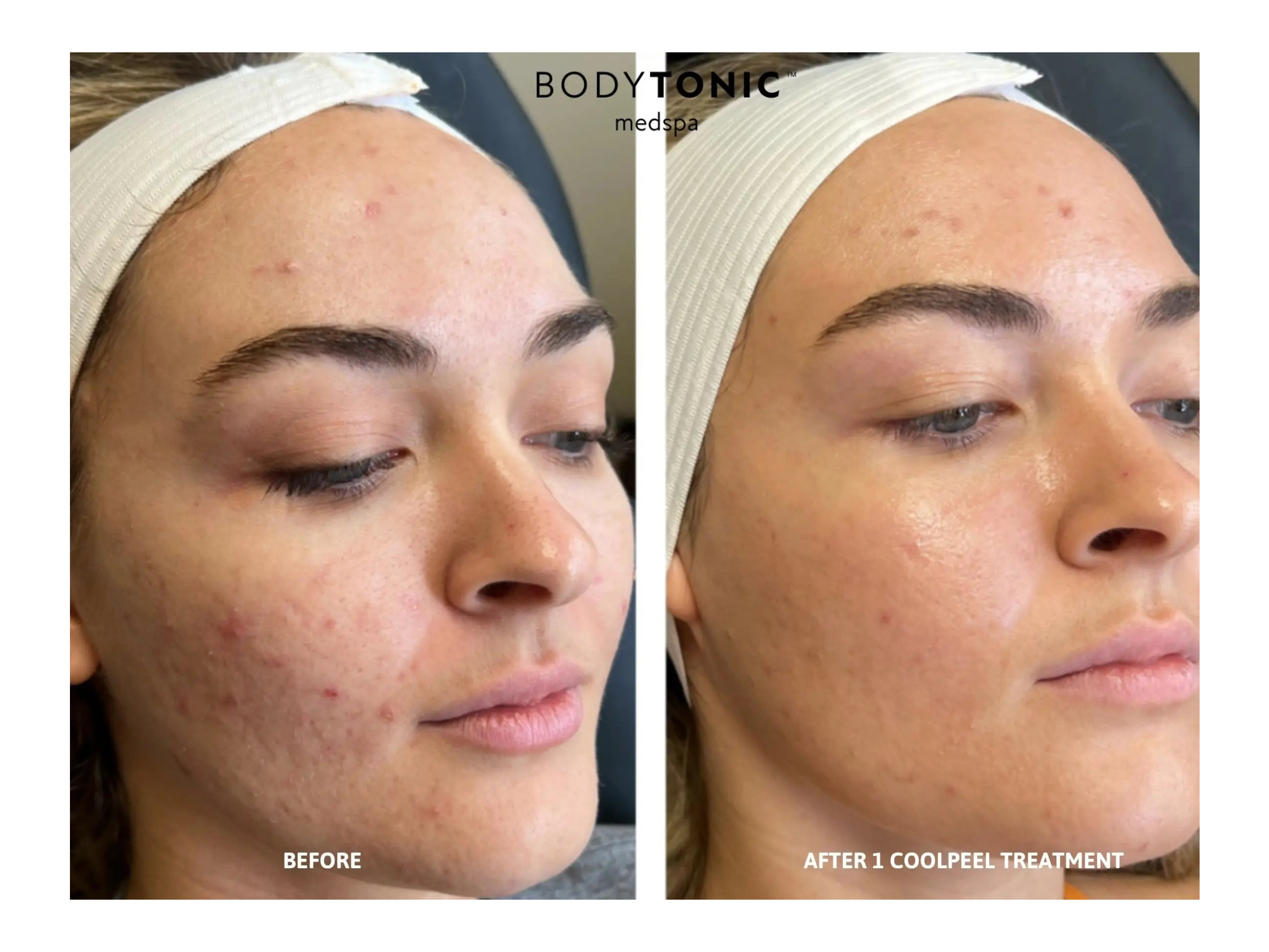 Before and after one Tetra CoolPeel treatment showing smoother skin texture at BodyTonic Med Spa Cleveland.