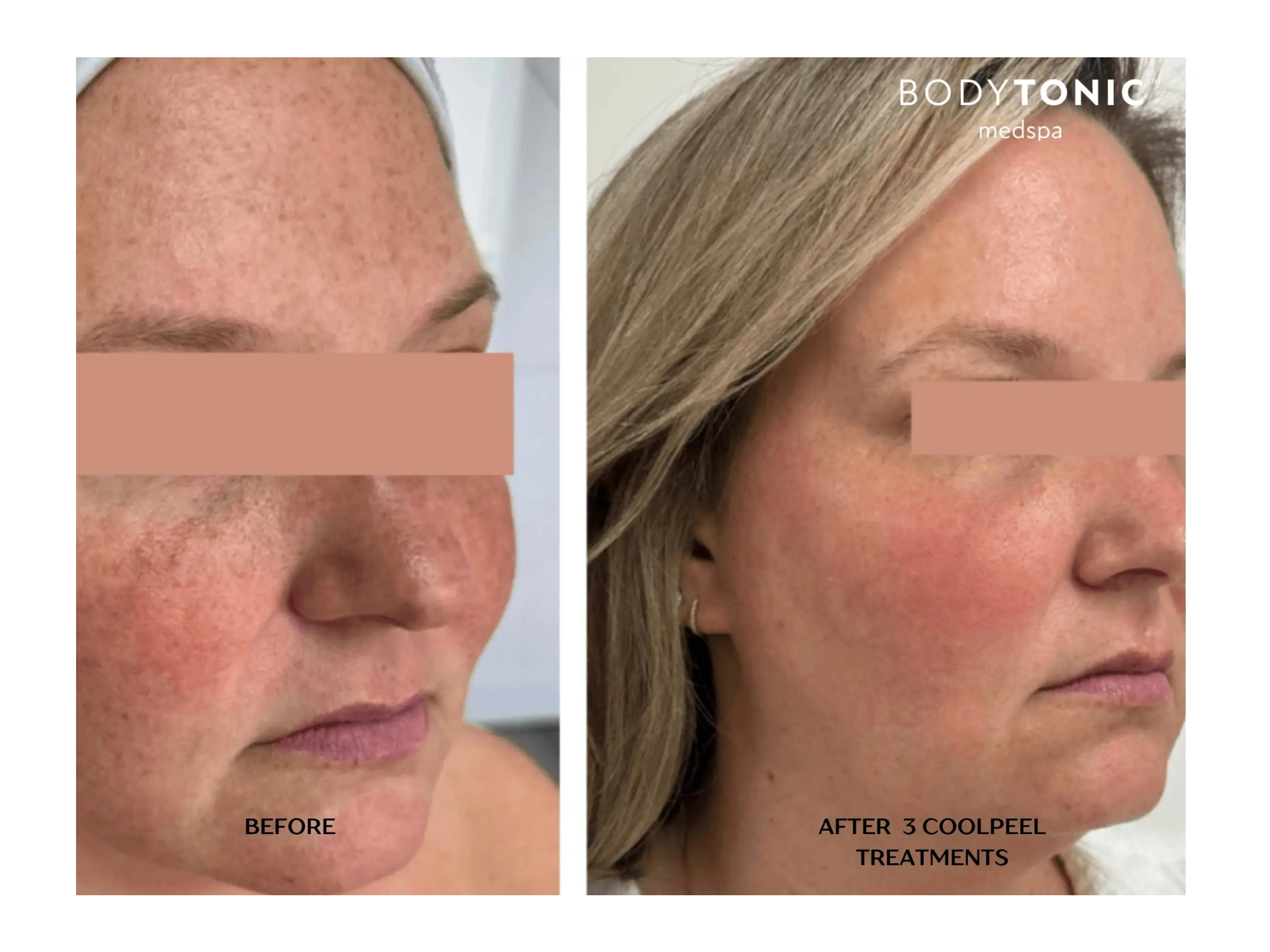 Before and after one Tetra CoolPeel treatment showing smoother skin color and texture at BodyTonic Med Spa Cleveland.