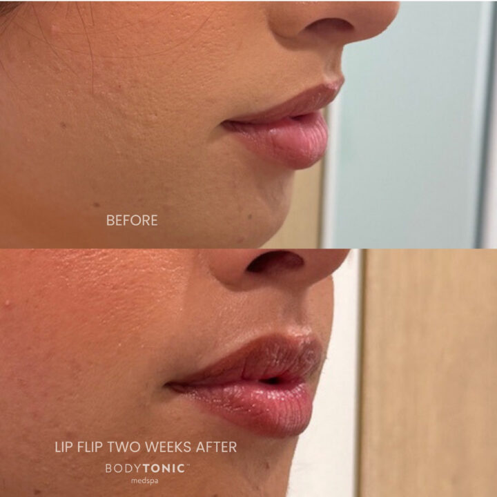Side profile of a woman showing before and after results of a lip flip treatment at BodyTonic Medspa, with noticeable lip lift and enhanced upper lip volume two weeks post-procedure.