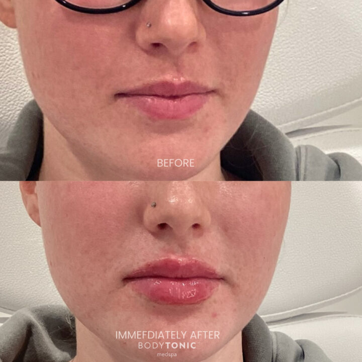 Frontal view of a woman before and immediately after a lip flip treatment at BodyTonic Medspa, highlighting fuller, more defined lips with a natural appearance.