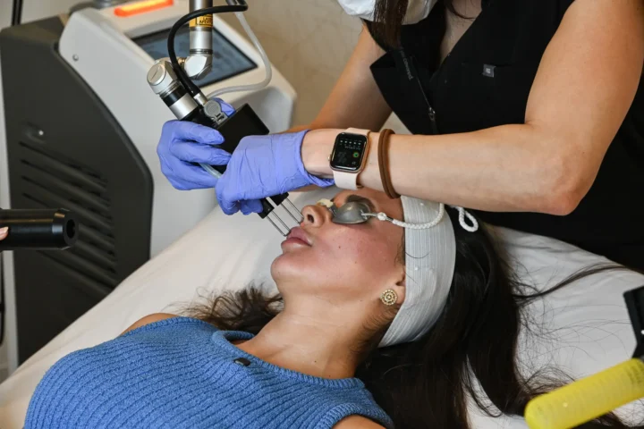 a photo during a coolpeel CO2 treatment at BodyTonic medspa, Cleveland. Ohio