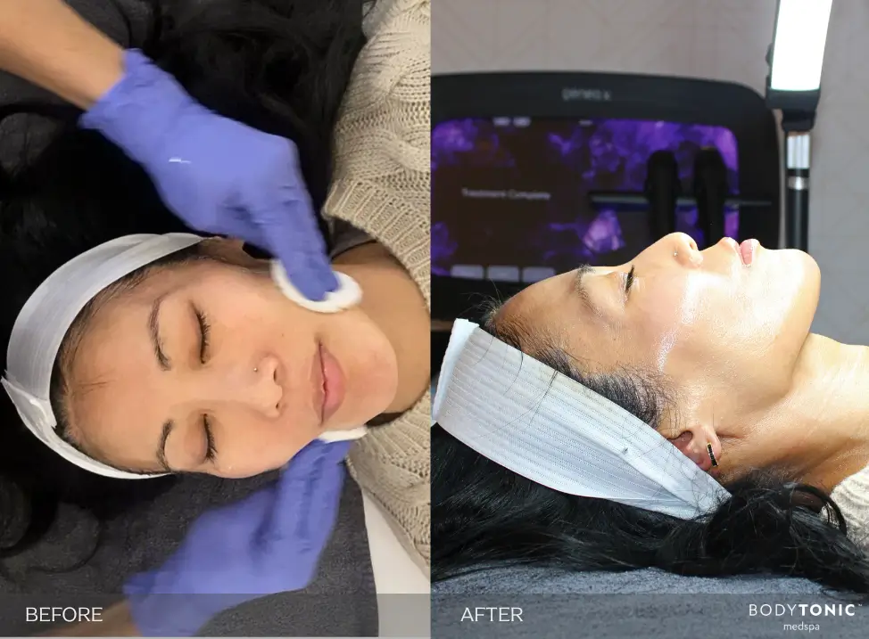 Glo2facial oxygen facial treatment in Cleveland, Ohio
