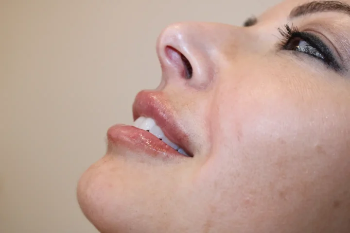 Close-up side profile of a woman’s lower face and lips after receiving cosmetic fillers, showing smooth skin and natural results at BodyTonic Medspa. Cleveland, Ohio