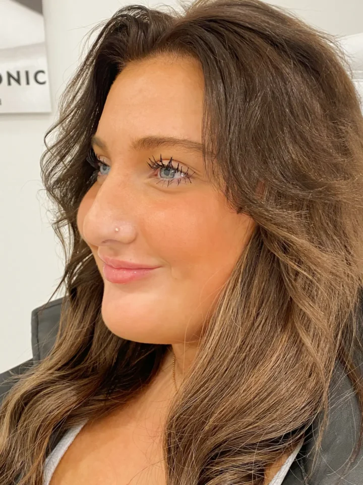 A close-up image of a woman receiving a cosmetic fillers treatment, showcasing lifted cheeks and defined features. Expertly administered dermal fillers like Juvederm®, Restylane®, and Radiesse® enhance natural beauty, smooth wrinkles, plump lips, and reduce under-eye bags. Discover FDA-approved cosmetic fillers for instant, natural-looking results with no downtime. Book your consultation for personalized hyaluronic acid or bio-stimulator treatments at BodyTonic Med Spa. Cleveland, Ohio.