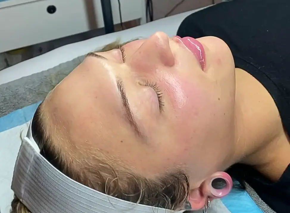 A close up of a client after having a medical facial done in Cleveland at Bodytonic Medspa