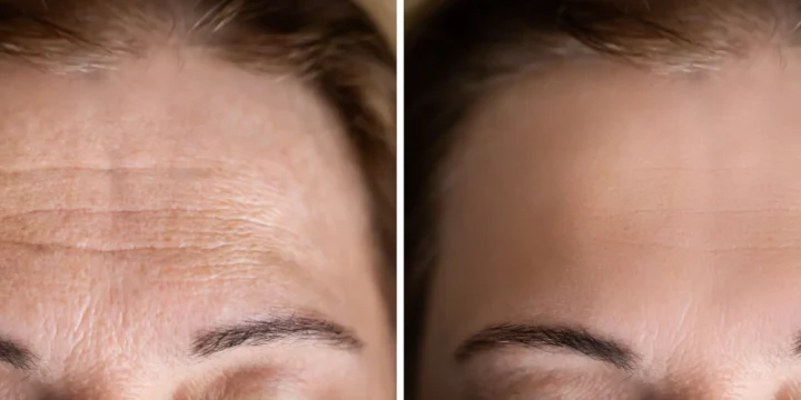 Close-up before and after of wrinkle relaxer treatment on a woman’s forehead at BodyTonic Medspa in Cleveland, showing visibly smoother expression lines.