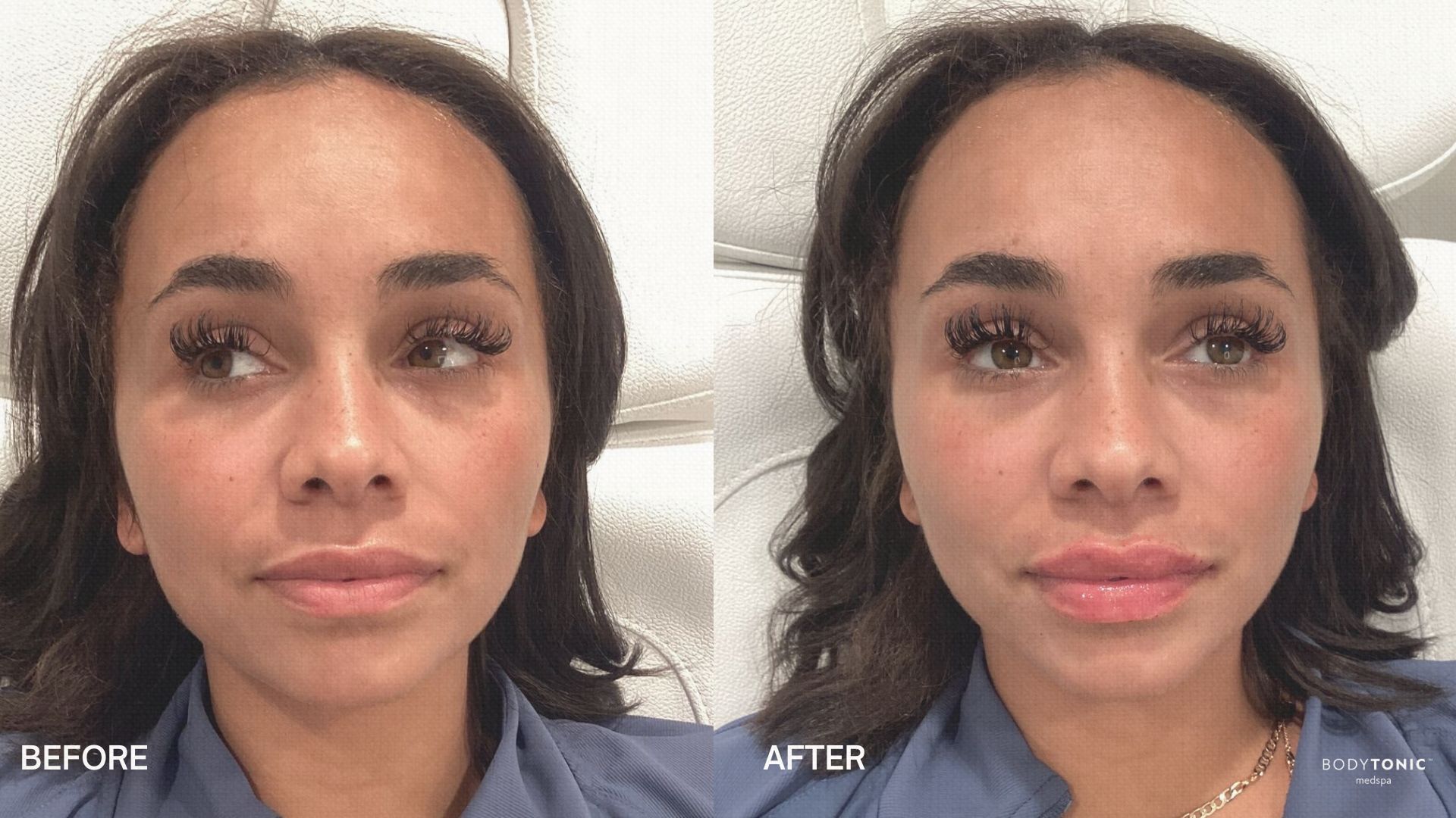 Before and after comparison showing the natural enhancement of lips following hyaluronic acid filler treatment. Treatment performed at Bodytonic medspa in Cleveland, OH.