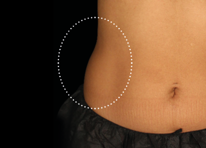 Emsculpt Neo abs before photo showing female lateral abdomen and flank area at BodyTonic Med Spa Cleveland