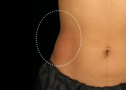 Emsculpt Neo abs after photo showing redefined waistline and toned flank muscles at BodyTonic Med Spa Cleveland
