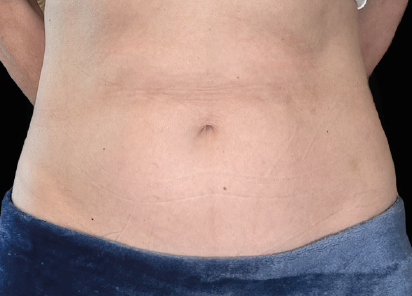 Same woman's midsection after Emsculpt Neo abs treatment at BodyTonic Med Spa Cleveland, showing reduced fat and defined abdominal muscles