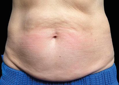 Woman's midsection before Emsculpt Neo abs treatment at BodyTonic Med Spa Cleveland, showing untoned stomach area