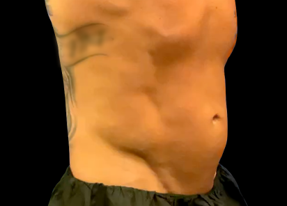 Emsculpt Neo abs before photo showing male lateral abdomen at BodyTonic Med Spa Cleveland prior to core strengthening treatment