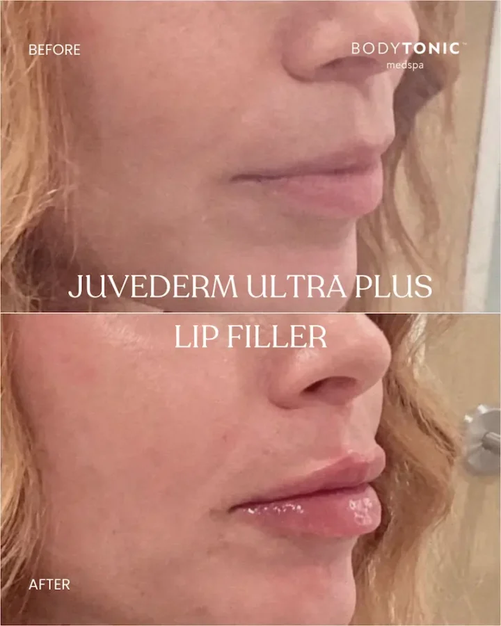 Before and after comparison of a woman’s lips treated with cosmetic fillers and hyaluronic acid at BodyTonic Med Spa. The 'before' image shows thin lips, while the 'after' image highlights fuller, defined lips enhanced with Juvederm Ultra Plus hyaluronic acid filler. Discover expert cosmetic fillers for natural lip augmentation and rejuvenation with no downtime. Book your consultation today!