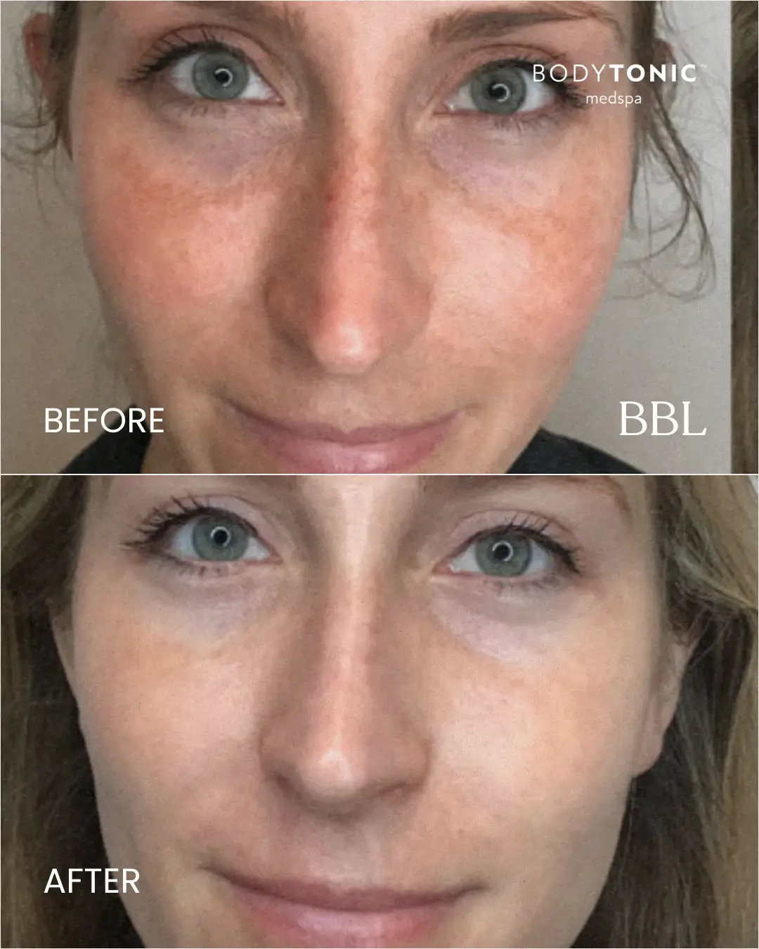 Before-and-after results showing reduction of sunspots on the face and more even skin tone following professional laser treatment at a BodyTonic medspa.